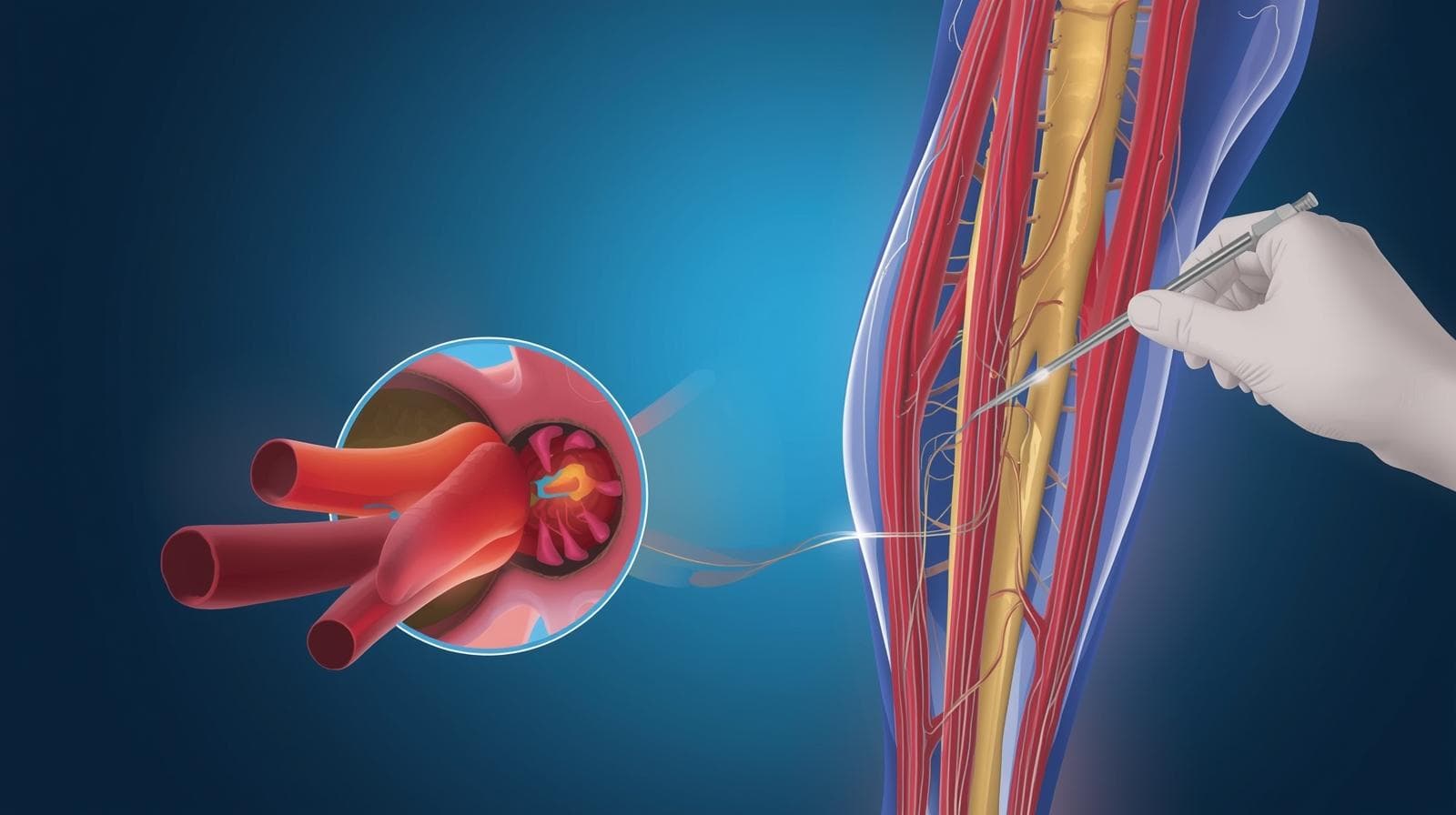 Tratamiento Especializado en la Enfermedad Arterial Periférica